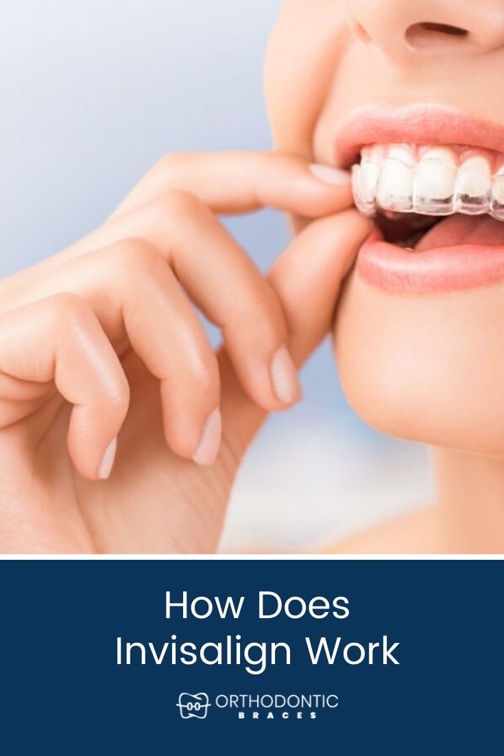 How Does Invisalign Work