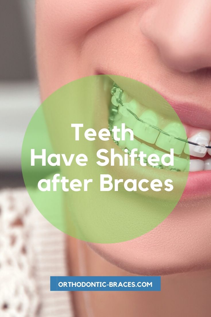 Teeth Have Shifted after Braces What to do