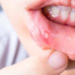 Canker sores from braces