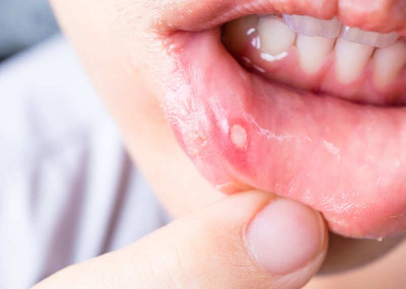 Canker sores from braces