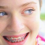 how to prepare for braces dental