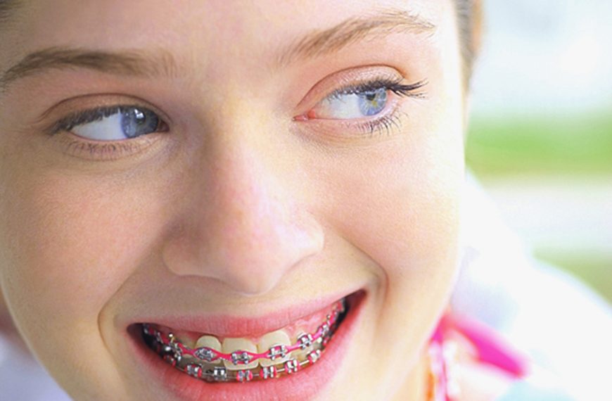How to Prepare for Braces