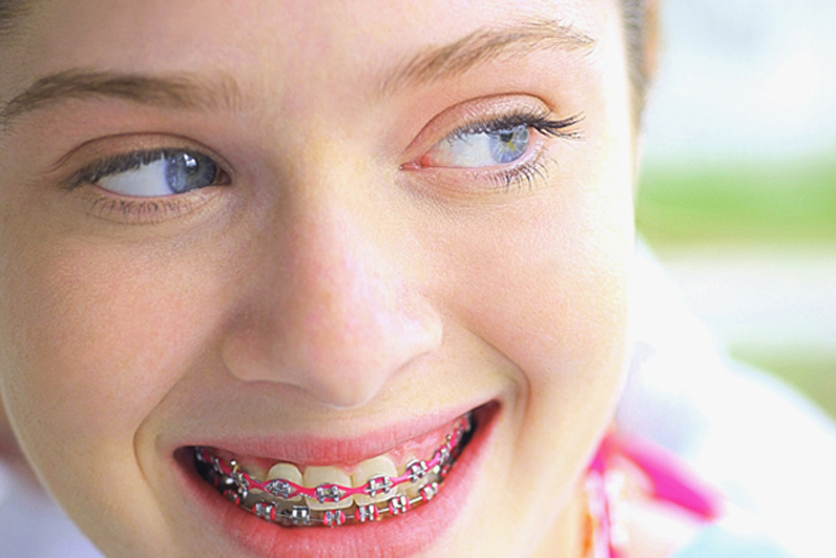 how to prepare for braces dental