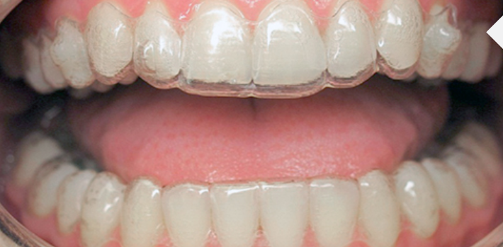 Invisalign tracking - upper arch is not tracking properly